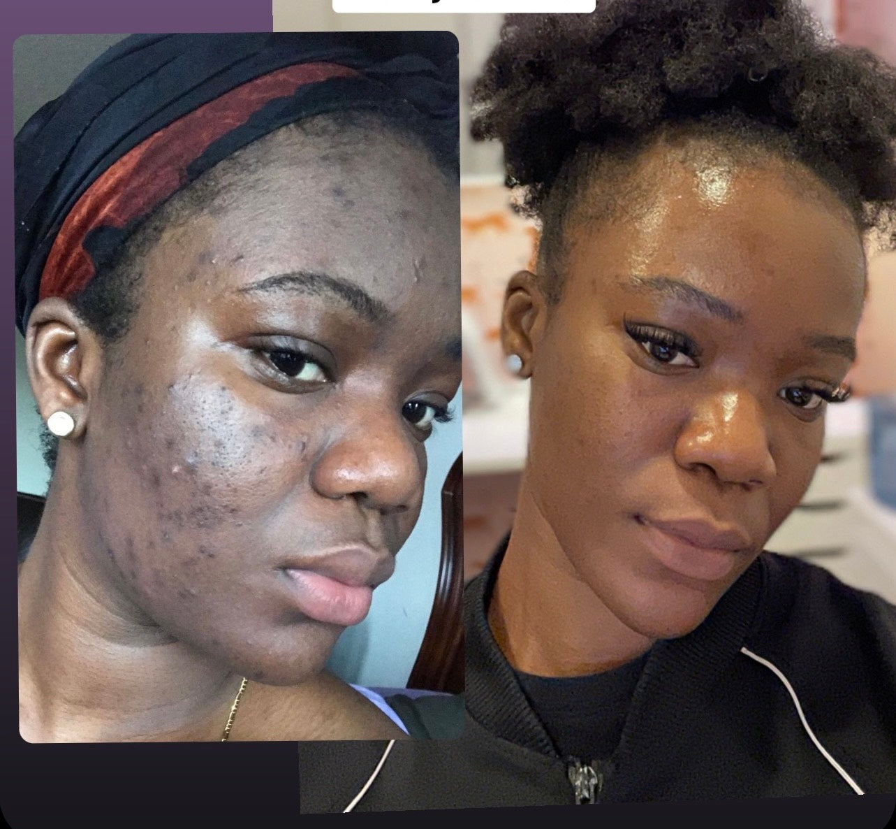 Boss Premium DermaGlow™ LED Therapy Mask